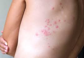 How To Tell Bed Bug Bites Apart From Mosquito Bites